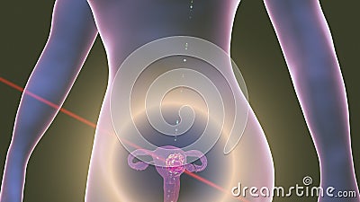 Uterine cancer, illustration Cartoon Illustration