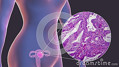 Uterine cancer, illustration and micrograph Cartoon Illustration