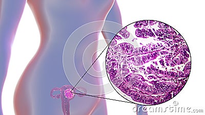 Uterine cancer, illustration and micrograph Cartoon Illustration