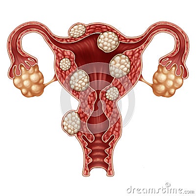Uterine Fibroid Stock Photo