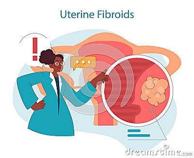 Uterine fibroids. Doctor illustrates uterine fibroids condition, zooming Vector Illustration