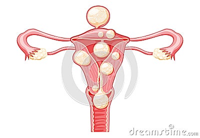 Uterine fibroids Female leiomyomas reproductive system uterus. Front view. Human anatomy medical illustration isolated Vector Illustration