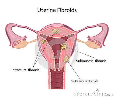 Uterine Fibroids Illustration Vector Illustration