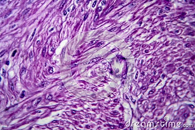 Uterine leiomyoma, light micrograph Stock Photo