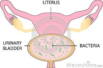 Uterine polyps. Human realistic uterus. Anatomy illustration Cartoon Illustration