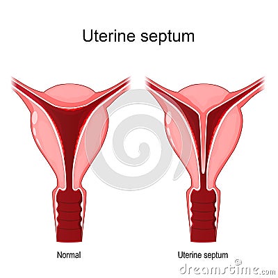 Uterine septum. female reproductive system. Vector Illustration