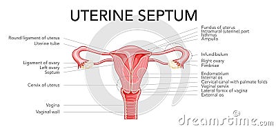 Uterine septum septate uterus Female reproductive system diagram with inscriptions text. Front view in a cut. Human Vector Illustration