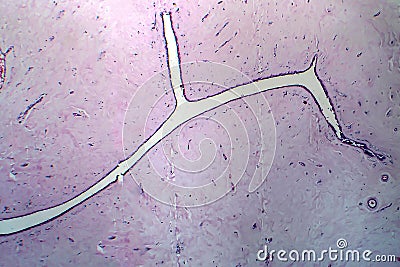 Uterus adenofibroma, light micrograph Stock Photo