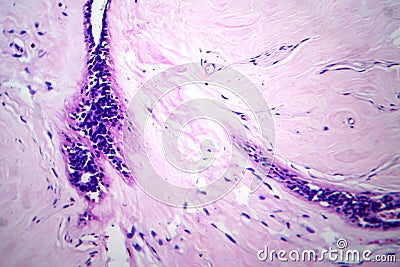 Uterus adenofibroma, light micrograph Stock Photo