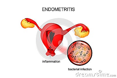 The uterus affected by endometriosis Vector Illustration