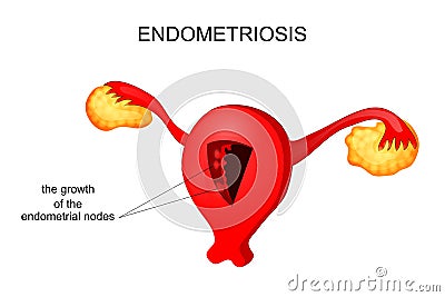 The uterus affected by endometriosis Vector Illustration