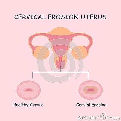 Uterus and cervical erosion Vector Illustration