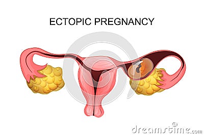 Uterus with ectopic pregnancy Stock Photo