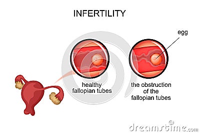 Uterus.infertility due to obstruction of the fallopian tubes Vector Illustration