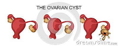 Uterus and ovarian cyst Vector Illustration