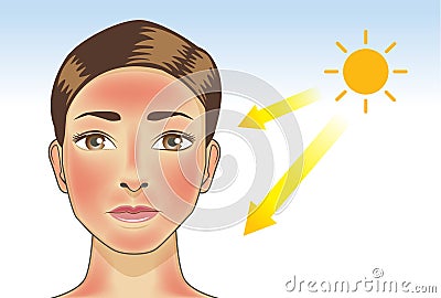 UV ray from sun made the redness appear on woman facial and neck skin. Vector Illustration