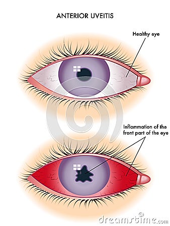 Uveitis Vector Illustration