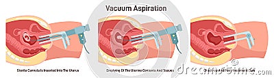 Vacuum aspiration set. Embryo or fetus vacuum removing. First trimester Cartoon Illustration