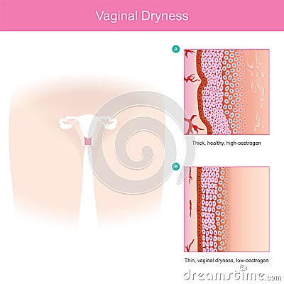 Vaginal Dryness. Stock Photo