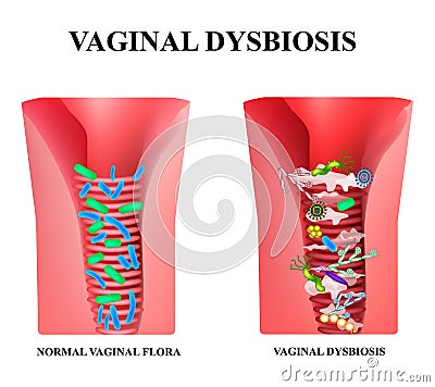 Vaginal dysbiosis. Dysbacteriosis of the vagina. Vaginitis Candidiasis. Lactobacillus, bifidobacteria. Bacteria pathogenic flora. Vector Illustration