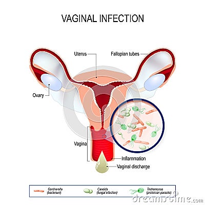 Vaginal infection and causative agents of vulvovaginitis. Vector Illustration