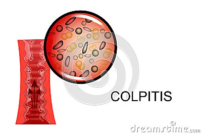 Vaginal mucosa affected by obesity. Vector Illustration