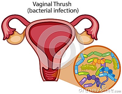 Vaginal Thrush on White Background Vector Illustration