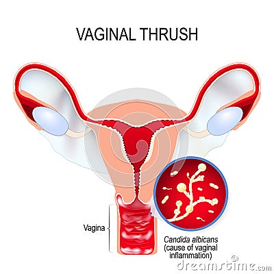 Vaginal yeast infection and Candida albicans Vector Illustration