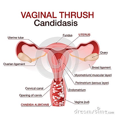 Vulvovaginal candidiasis or vaginal yeast infection.Vector illustration Vector Illustration