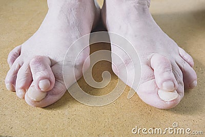 Valgus Deformity of Female Leg Due Hallux Valgus and Weakness of Ligaments Stock Photo