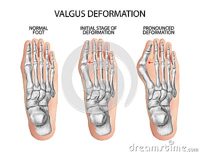 Valgus deformity of the toes. Cartoon Illustration