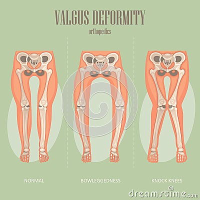 Valgus deformity. Vector medical poster. Vector Illustration