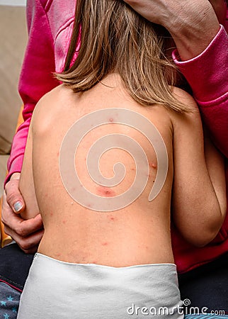 Varicella zoster virus or Chickenpox bubble rash on child, baby Stock Photo