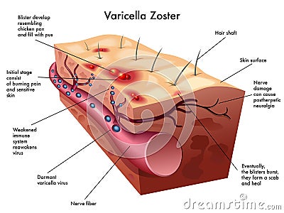 Varicella zoster virus Vector Illustration