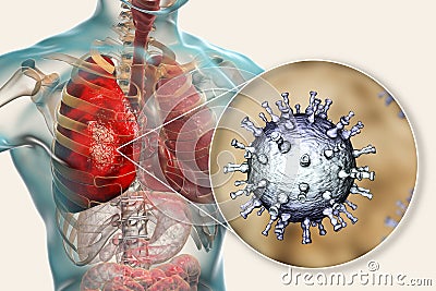 Varicella zoster virus pneumonia, chickenpox complication Stock Photo