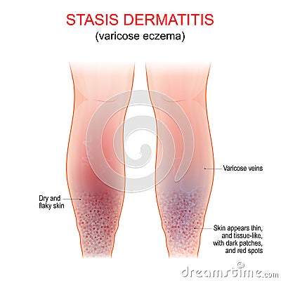 Varicose eczema. Symptoms of venous, gravitational or stasis dermatitis Vector Illustration