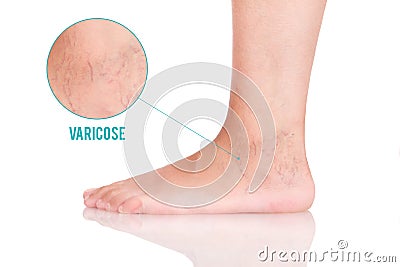 Varicose on the foot. Stop with varicose on a white background Stock Photo