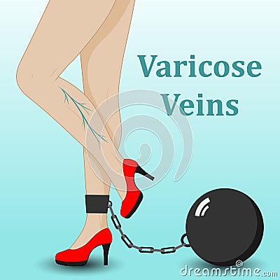 Varicose Vector Illustration