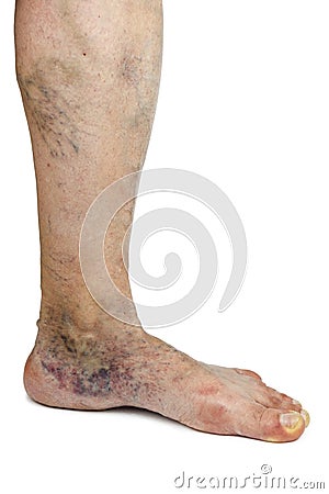 Varicose vein Stock Photo