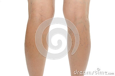 Varicose vein. Isolated Stock Photo