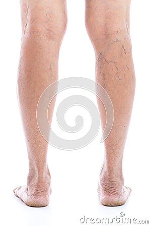 Varicose vein Isolated on white Stock Photo