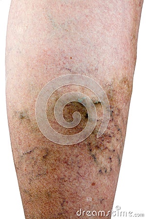 Varicose vein Stock Photo