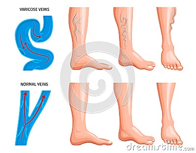 Varicose Veins Anatomy Realistic Set Vector Illustration