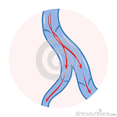 Varicose veins. Blue blood vessel visible through the skin. Vascular disease diagnostic and treatment. Venous Vector Illustration