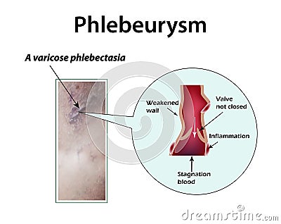 Varicose veins bronchiectasis. Cartoon Illustration