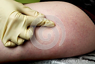 Varicose veins and capillary veins in the legs. Medical inspection and treatment Stock Photo