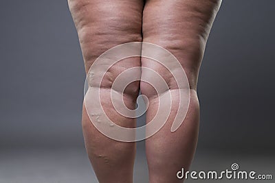 Varicose veins closeup, fat female cellulite legs Stock Photo