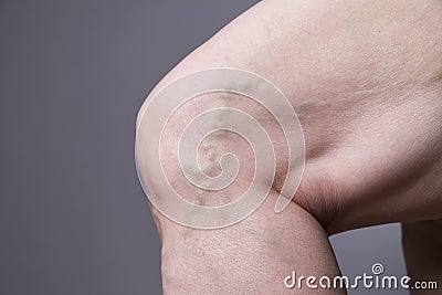 Varicose veins closeup. Thick female legs Stock Photo