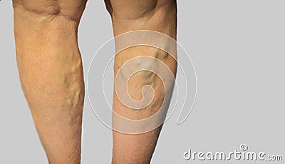 Varicose veins on a female legs Stock Photo