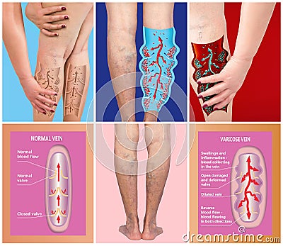 Varicose veins on a female senior legs. The structure of normal and varicose veins Stock Photo
